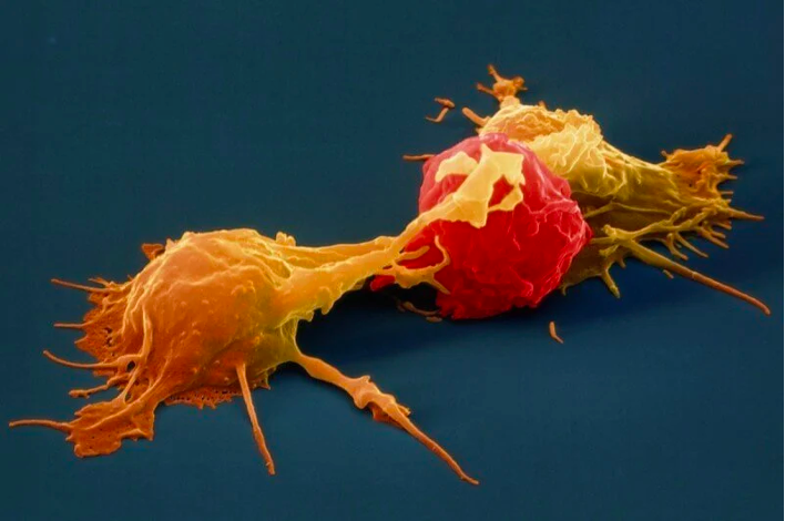 抗肿瘤第一道防线——NK 细胞疗法